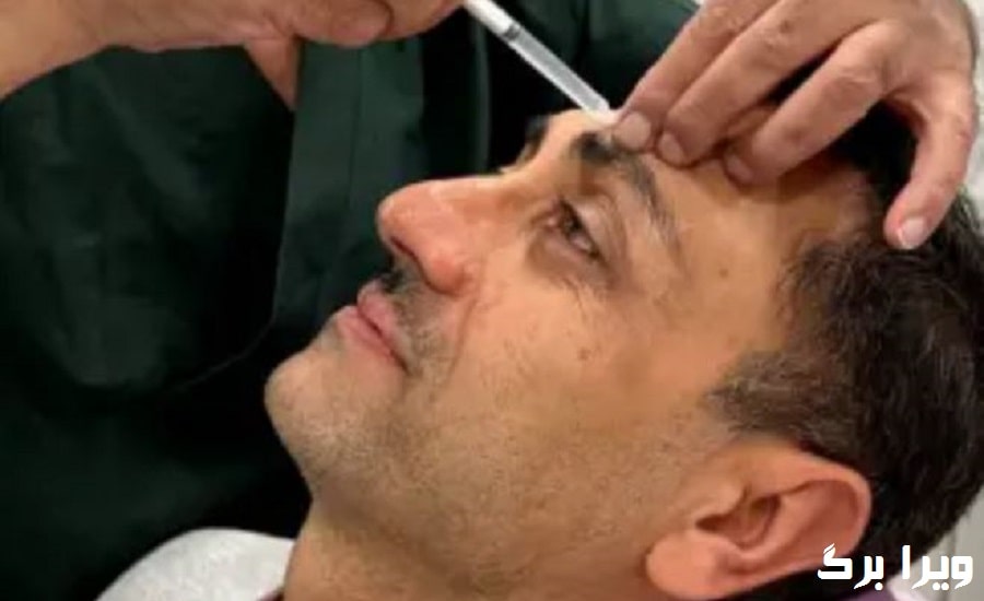 تزریق ژل بوتاکس صورت و دیگر نواحی در کلینیک لوتوس